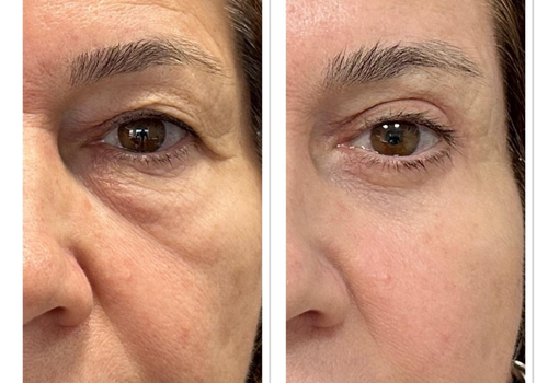 Paciente com Dermatocalase em pálpebras superiores e inferiores, submetida a blefaroplastia superior, blefaroplastia inferior e lifting de terço médio da face.
