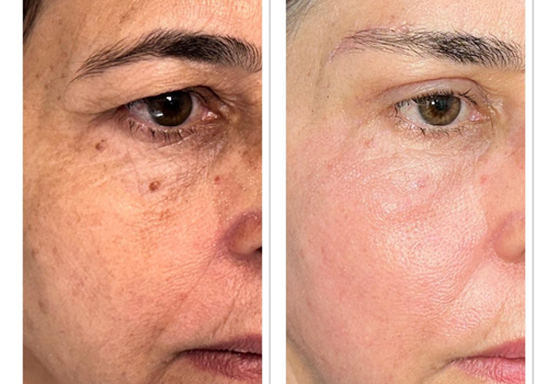 Paciente com Dermatocalaze em pálpebras superiores e ptose de sobrancelhas. Submetida a blefaroplastia superior, levantamento direto de supercílios e resurfacing facial com laser de CO2.